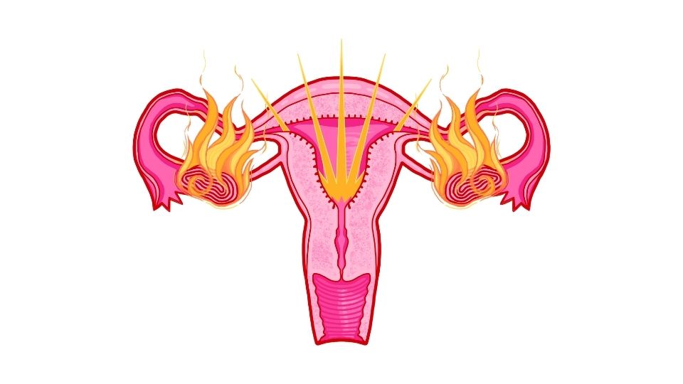 pcos